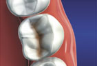 Restoring health and strength to a natural tooth structure Inlays to the natural tooth structure