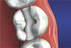 The decayed portion of the tooth is removed Decayed tooth inlay