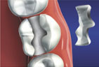 An inlay is fabricated to match the look and feel of your natural teeth An Inlay is fabricated