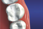 The restoration makes it so the inlay blends into the natural tooth structure Inlay Blending